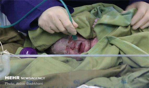 جراحی حذف جنین دچار اختلال در بارداری دوقلوهای همسان در شیراز