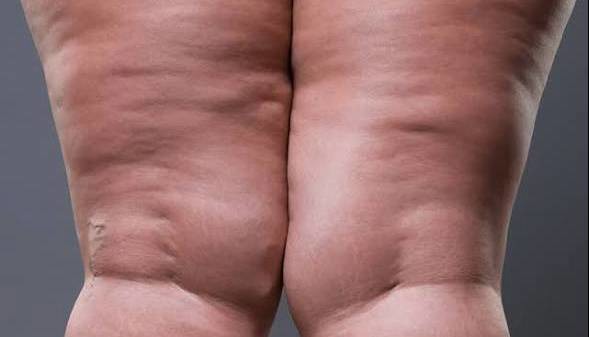 چربی ذخیره در پا از بیماری است نه چاقی!